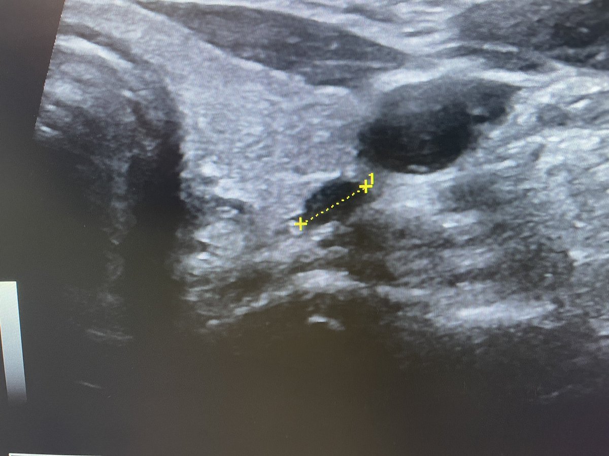 WilliamRBlythe's tweet photo. Axial & Saggital view of parathyroid adenoma on US, and on back table. 15 min focused parathyroidectomy. PTH 135 -> 32 in PACU.
#ENTwitter #Photolaryngology #GeneralENT https://t.co/jzmsO5TQg4