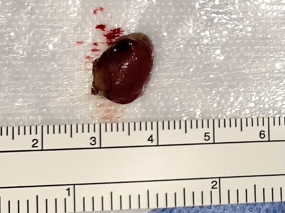 WilliamRBlythe's tweet photo. Axial & Saggital view of parathyroid adenoma on US, and on back table. 15 min focused parathyroidectomy. PTH 135 -> 32 in PACU.
#ENTwitter #Photolaryngology #GeneralENT https://t.co/jzmsO5TQg4