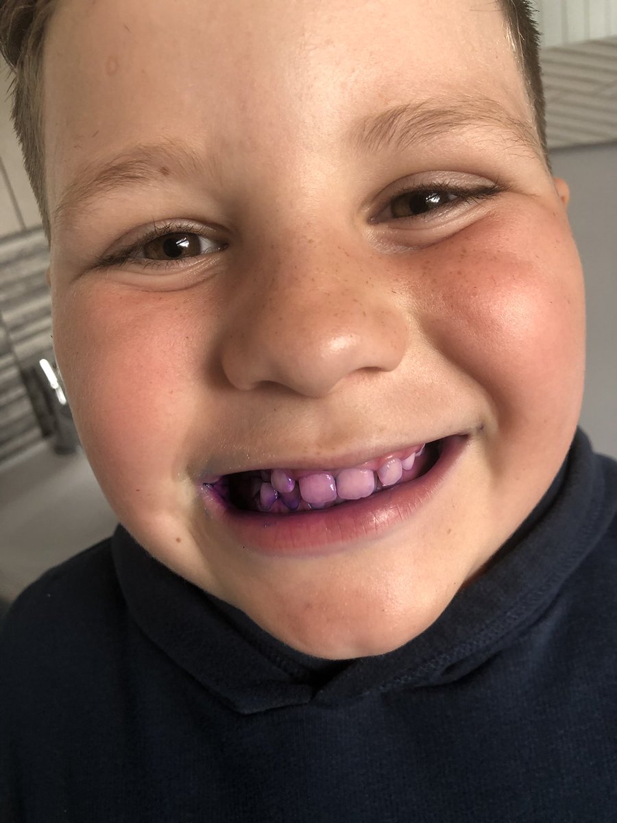 nicolarostron2's tweet photo. @StJamesYear3 Declan was excited to do his plaque reveal today after school! Here are the results! 🦷 https://t.co/4xv9YhKQHY