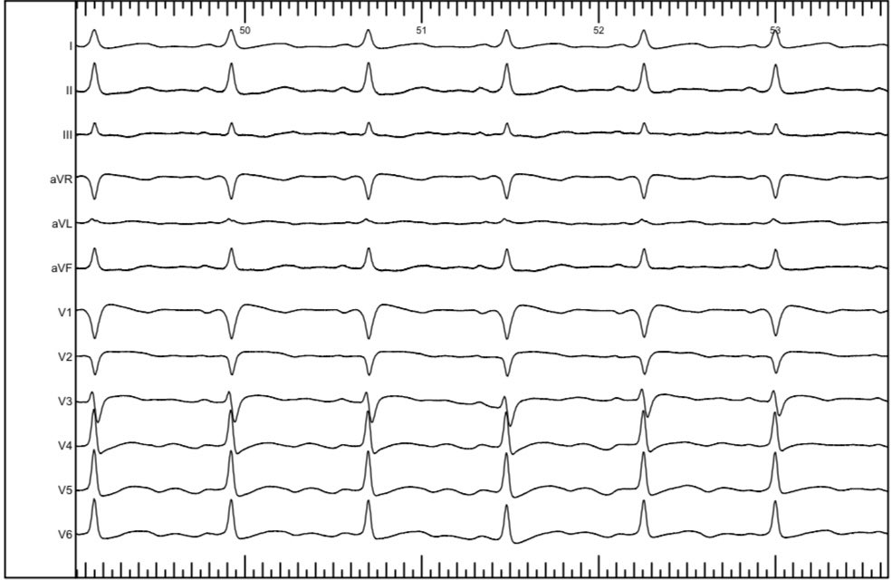 DrV_Mann's tweet photo. 14 years with ADHD, asymptomatic pre-excitation @ep_bremen. To ablate or not to ablate? 🧐
RVA in HRA; RF 1/2 @ His (sorry for the tiny his🤷‍♂️)
@AGEP_DGK @DGK_org @LukerJakob @bordistef @SergioRichterMD @narrowQRS @pedirhythm @Dominik_Linz @DavidDuncker @HenrikeHillmann @YoungDgk https://t.co/nY6mwBnZyH