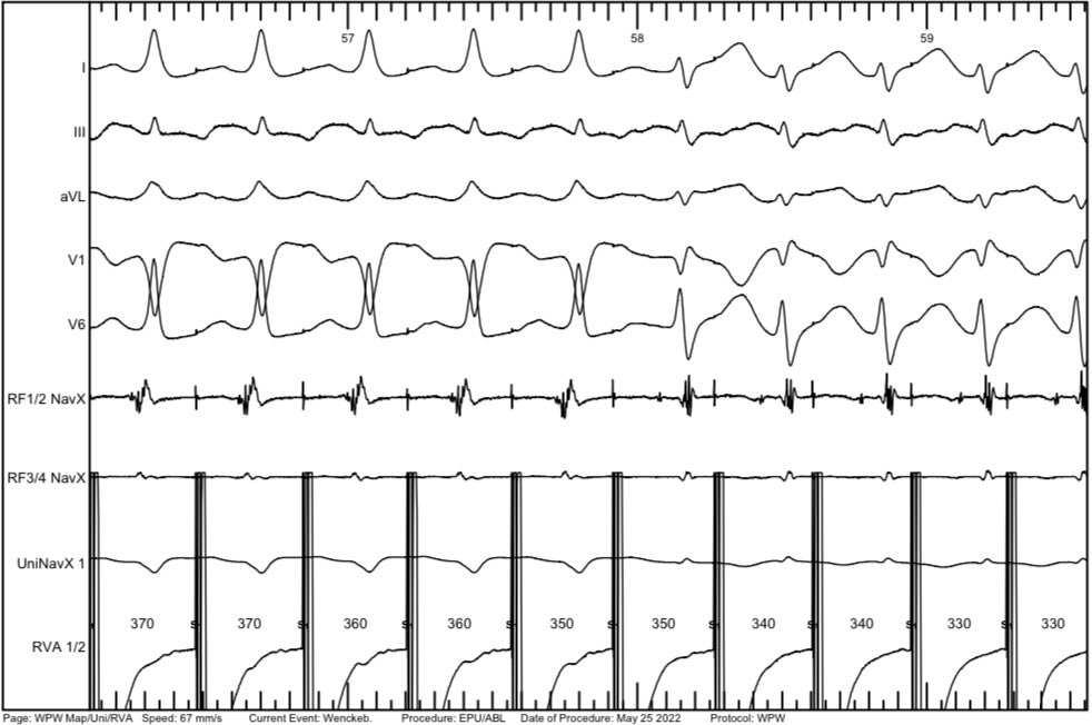 DrV_Mann's tweet photo. 14 years with ADHD, asymptomatic pre-excitation @ep_bremen. To ablate or not to ablate? 🧐
RVA in HRA; RF 1/2 @ His (sorry for the tiny his🤷‍♂️)
@AGEP_DGK @DGK_org @LukerJakob @bordistef @SergioRichterMD @narrowQRS @pedirhythm @Dominik_Linz @DavidDuncker @HenrikeHillmann @YoungDgk https://t.co/nY6mwBnZyH