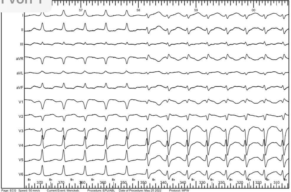 DrV_Mann's tweet photo. 14 years with ADHD, asymptomatic pre-excitation @ep_bremen. To ablate or not to ablate? 🧐
RVA in HRA; RF 1/2 @ His (sorry for the tiny his🤷‍♂️)
@AGEP_DGK @DGK_org @LukerJakob @bordistef @SergioRichterMD @narrowQRS @pedirhythm @Dominik_Linz @DavidDuncker @HenrikeHillmann @YoungDgk https://t.co/nY6mwBnZyH