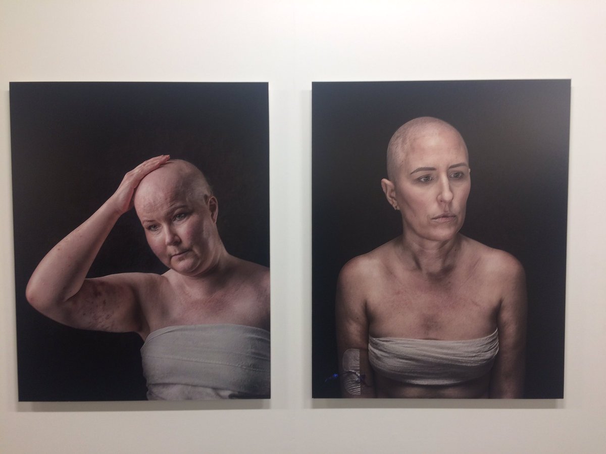 An amazing must-see-show @BelfastExposed by photographer Jennifer Willis, #SeenToBeHeard powerful on so many levels. A tribute to all 'who bravely bare their scars'...go see before it ends this Saturday #acnisupported