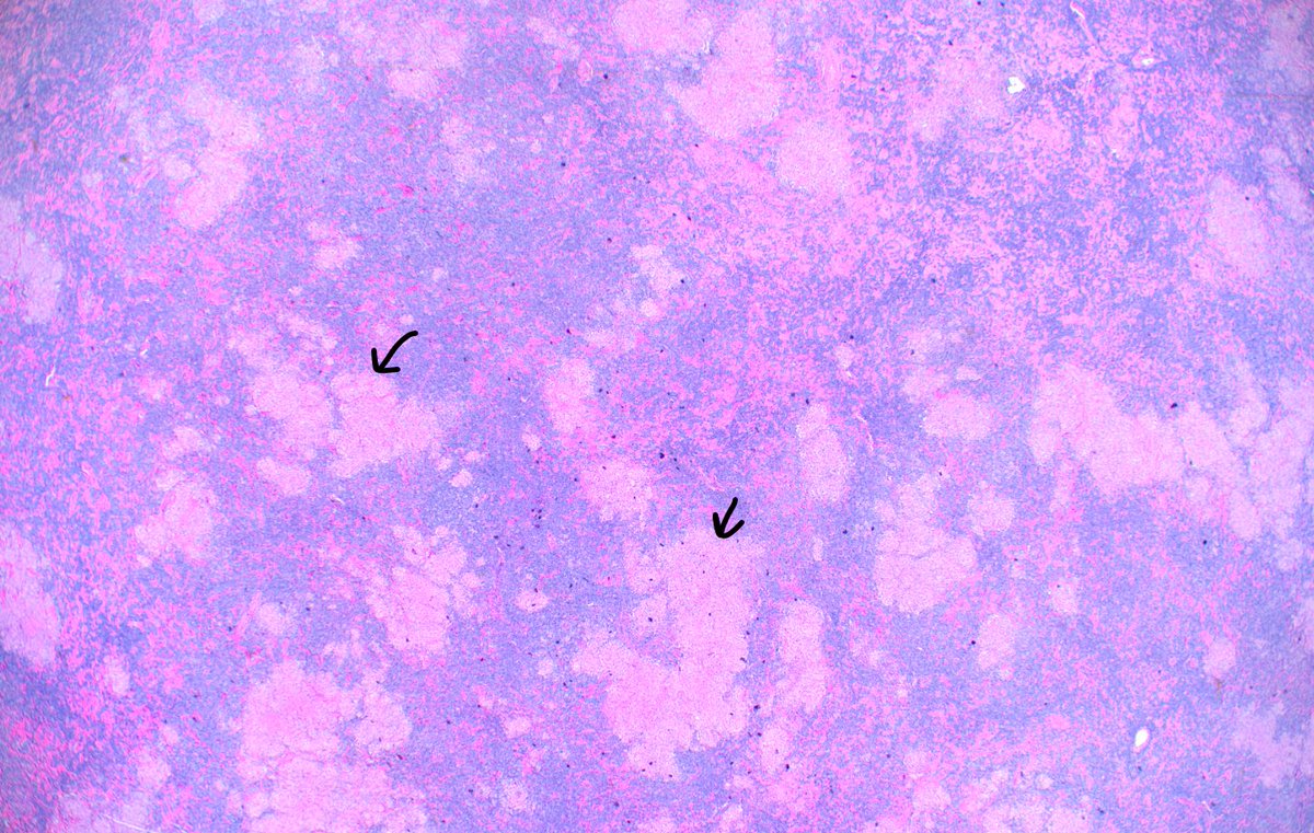 #Never_stop_at_one_diagnosis :
Classic Hodgkin Lymphoma (CHL) with a granulomatous background (black arrows: granulomas) #hemepath #lymsm #pathtwitter #medtwitter