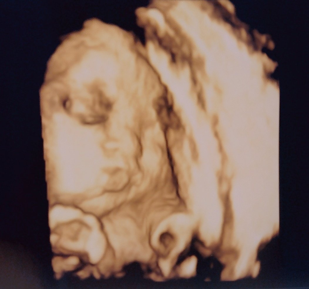 تويتر ママまえだ على تويتر エコーを向けたらkissしてくれました 最高に可愛い 直前まで手で顔隠してたのに 技師さんに お顔見せて ってお腹つんつんされたらパッと退けてくれてこの顔である この女 赤ちゃん さては策略か 可愛ければ何でも許さ