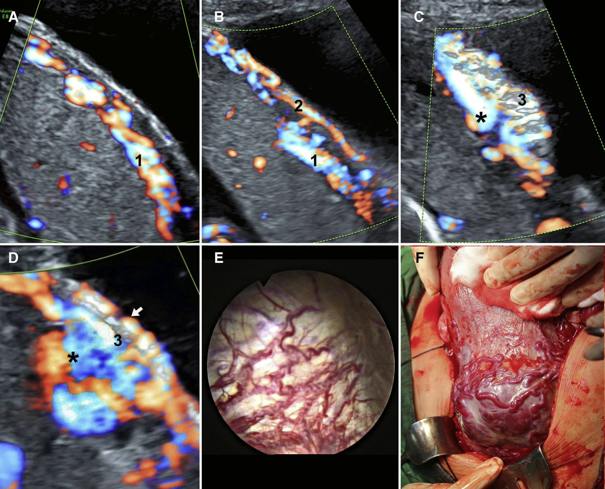 AJOG_thegray's tweet image. The “rail sign”: an ultrasound finding in placenta accreta spectrum indicating deep villous invasion and adverse outcomes ow.ly/4GeC50GbxYI