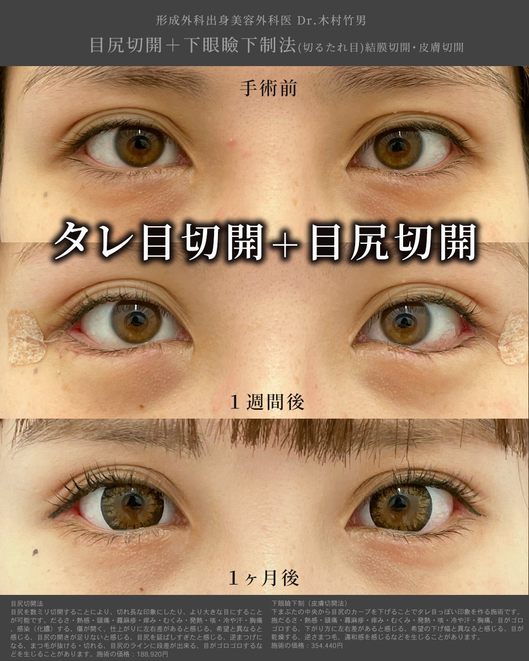 湘南美容クリニック武蔵小杉院 公式 タレ目形成 Sbc武蔵小杉院院長 木村竹男による タレ目切開 目尻切開 つり目 解消はもちろん 目を外側 下側に大きくすることが可能 なんだか垢抜けている メイク映えする という目になりたい方にもおすすめの