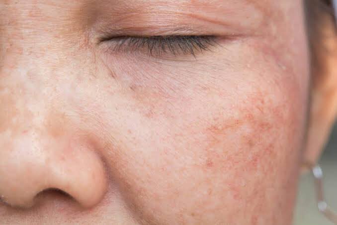 skinmurch's tweet photo. KULIT KUSAM
kira kira #simplegang disini ada yg kondisi wajahnya kusam kaya gini? uda pake berbagai macam produk tapi kulit tetap kusam dan ga fresh :(
percayalah kalian bakal temukan jawabannya di thread ini, 
gapake lama lagi yuk kita bahas kenapa dan cara merawatnya https://t.co/5uOhrJOGLP