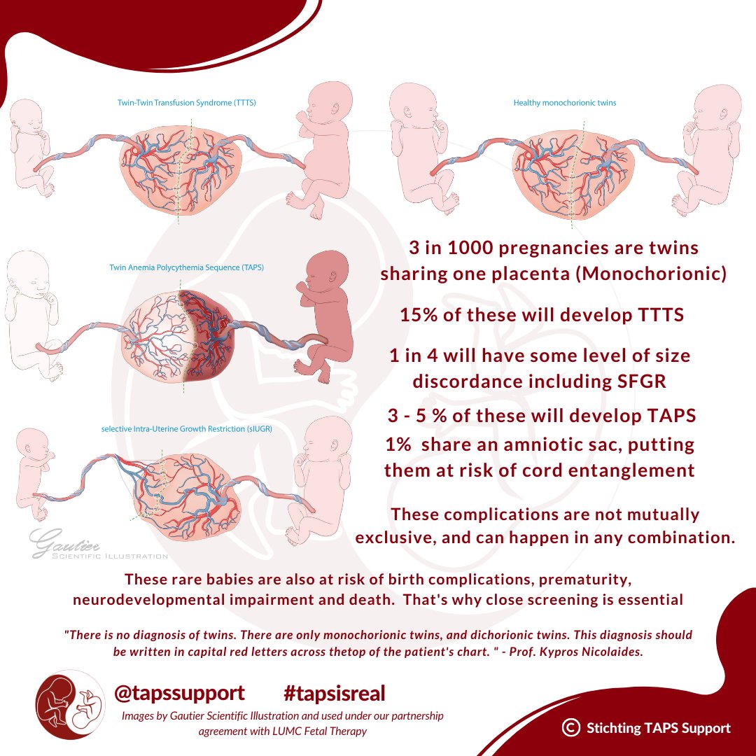 hjælpemotor udtryk Der er en tendens TAPS Support on Twitter: "Monochorionic twins are at risk of rare  complications like TTTS, TAPS, SFGR. They're also at an increased risk of  prematurity, neurodevelopmental impairment,&amp; death, which is why it's  important