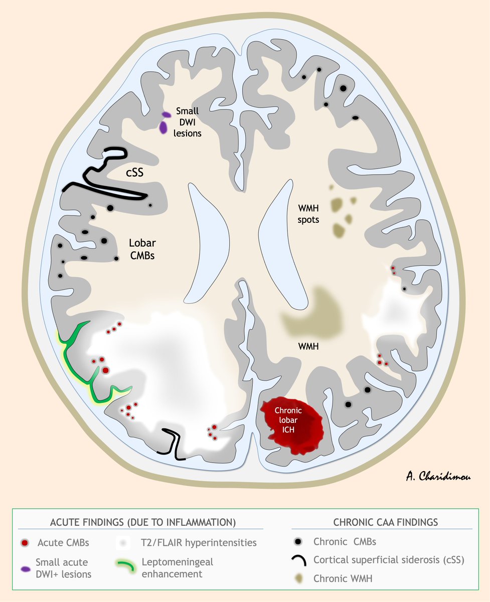 Andreas Charidimou MD, PhD (@a_charidimou) on Twitter photo 🤿🧠MRI features of Inflammatory Cerebral Amyloid Angiopathy
(version 1.0)
🔑 👇🏿
#neurotwitter #NeuroTwitter #NeuroRad #MedTwitter #MedStudentTwitter #MedEd #EndNeurophobia #Neurology #Neurosurgery #RadEd #stroke <a href="/gboulouis/">Gregoire Boulouis</a> <a href="/WorldStrokeEd/">World Stroke Academy</a> 🤿🧠MRI features of Inflammatory Cerebral Amyloid Angiopathy
(version 1.0)
🔑 👇🏿
#neurotwitter #NeuroTwitter #NeuroRad #MedTwitter #MedStudentTwitter #MedEd #EndNeurophobia #Neurology #Neurosurgery #RadEd #stroke <a href="/gboulouis/">Gregoire Boulouis</a> <a href="/WorldStrokeEd/">World Stroke Academy</a>