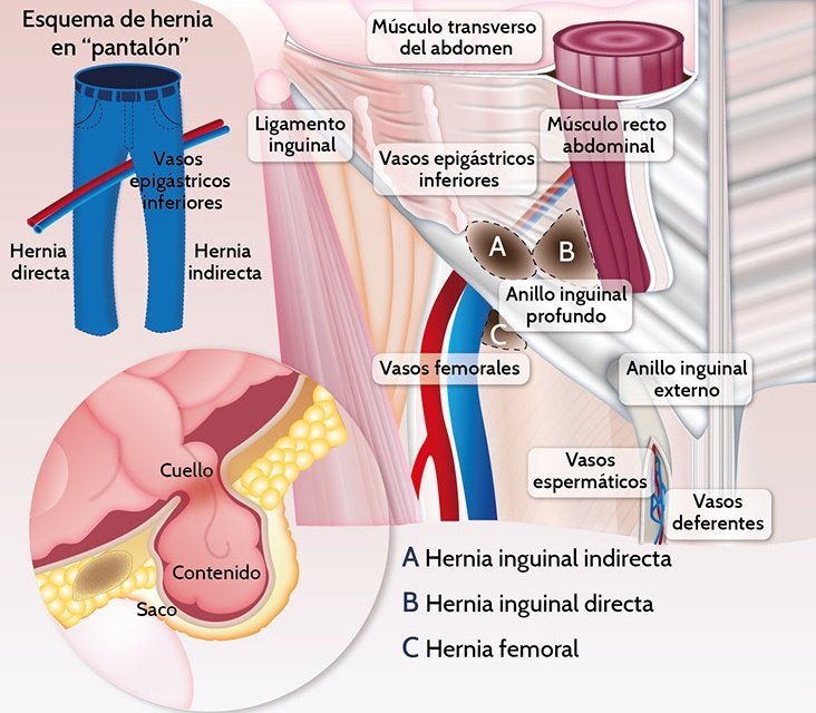 CirujanoGZ's tweet photo. La #hernia más común del ser humano es la hernia inguinal INDIRECTA. https://t.co/W2ufRmGcQt