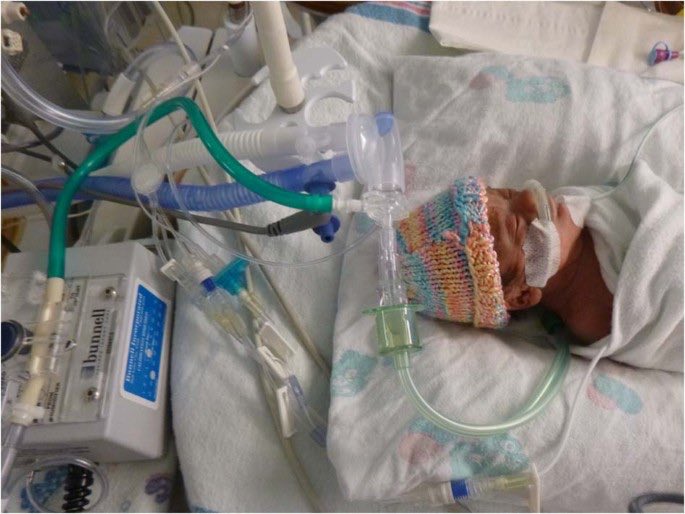 NICU_Musings's tweet photo. High frequency nasal oscillatory ventilation may work through prevention of apnoea to avoid intubation. 
Congrats to my team in #Winnipeg for this publication‼️
https://t.co/jwsAsV68T7
#neoTwitter https://t.co/nu0QQhAfbE