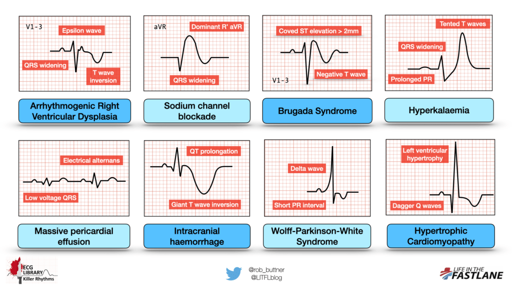 MedPostsSQU's tweet photo. KILLER ECGs ⚠️🫀  🫀⚠️

Recognition of any of these killer ECG patterns should prompt expedited medical assessment and treatment.

PART ONE: “Deadly Diagnoses Not To Miss” (the Non-ischaemic version…)

https://t.co/rjp0dKVZ0L https://t.co/fdEIZD0lDg