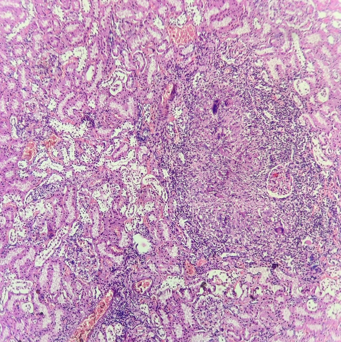 niyatis25's tweet photo. Case of disseminated tuberculosis- lungs,liver,kidney and spleen affected. #AutopsyPathology #PathBugs https://t.co/WyJeGQMTki
