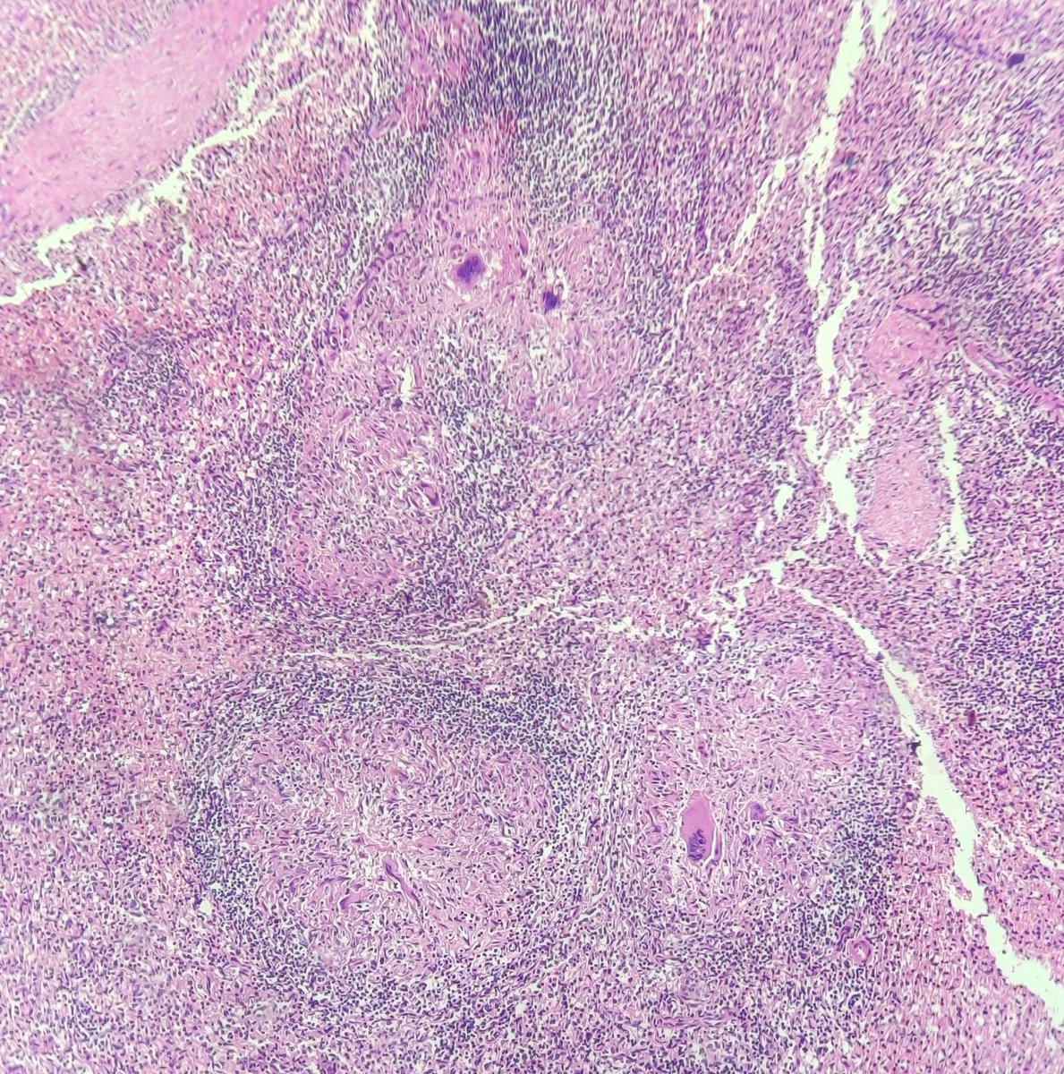 niyatis25's tweet photo. Case of disseminated tuberculosis- lungs,liver,kidney and spleen affected. #AutopsyPathology #PathBugs https://t.co/WyJeGQMTki