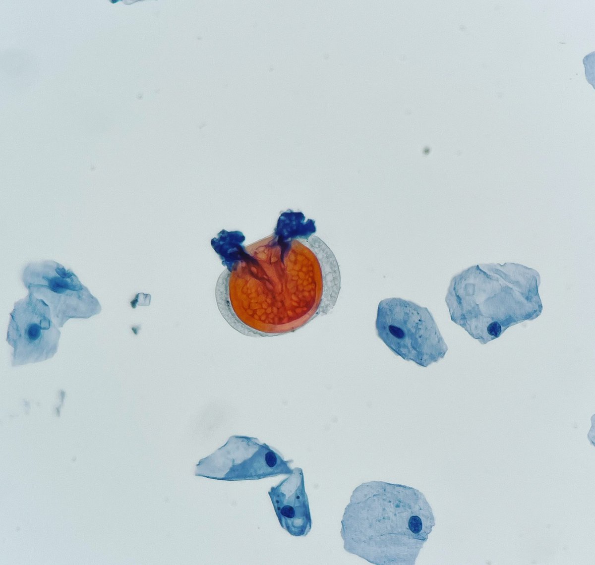 fetot's tweet photo. I don’t know what this is but looks to me like a tiny prostate with seminal vesicles 😄What a thick capsule, lol  #werkk #gupath #urinecytology https://t.co/Uecm5JKajq