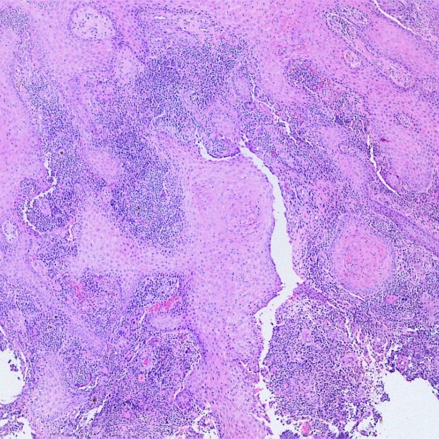 GeronimoJrLapac's tweet photo. Sometimes the hyperplasia is so pronounced that it can lead to a misdiagnosis of SCC. Suspect infection in the presence of intraepidermal abscesses. Do deep cuts if necessary. Here the organisms were very visible. Chromomycosis!

#dermpath #pathology https://t.co/GZZfkPEKg4