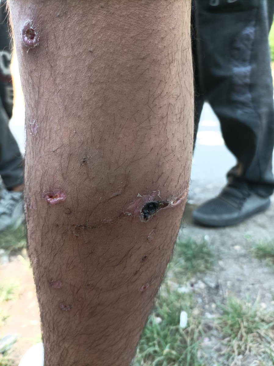 APC_CZA's tweet photo. Sombor,24/05/2022. Abdullah from Syria(16 years old) testified he suffered wounds on his leg from the bites of the #Croatia #borderpolice dogs, as he was stopped by force & #pushbacked to #Serbia. More than 400 people stay out of overcrowded reception center Sombor at the moment. https://t.co/uQxkMAGMoh