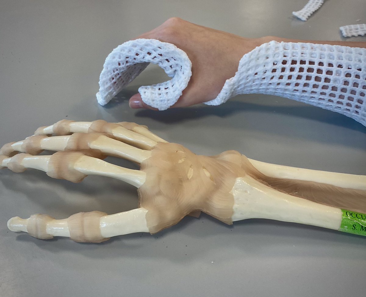 langley_daisy's tweet photo. Brilliant morning doing #CPD #HandTherapy 🙌🏼. We each had an opportunity to create a resting volar splint on each other using different materials. This is the one that Cathy modelled for me using X-lite. Followed by meeting the lovely Agnes💚#OccupationalTherapy #OT @OTCumbria https://t.co/uCvMzg2CWZ