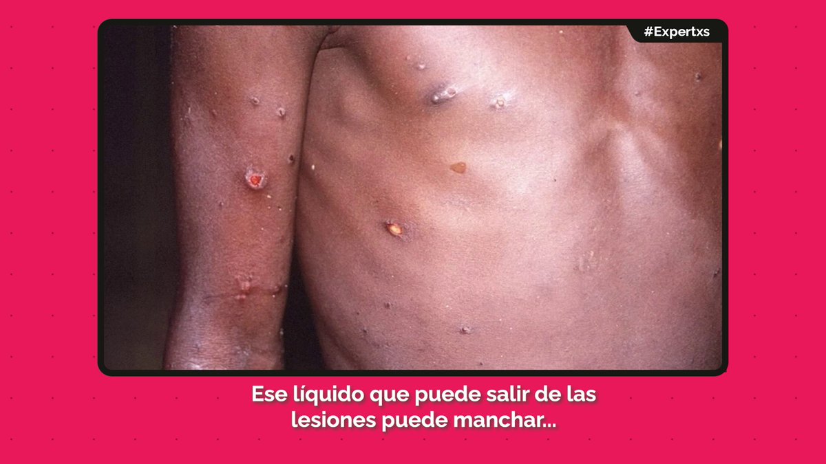 ManuDs81's tweet photo. Pronto en @rtvenoticias el formato #Expertxs 'La viruela del mono' https://t.co/hA5s2BdSez