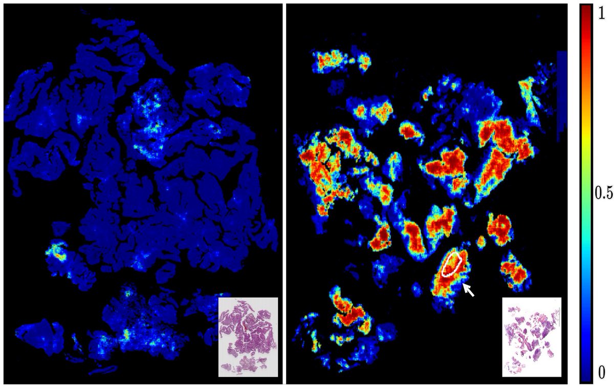 BMDLabUiS's tweet photo. Our BMDLab member Saul Fuster`s work on "Invasive Cancerous Area Detection in Non-Muscle Invasive Bladder Cancer Whole Slide Images" is accepted at IVMSP 2022. The article will be presented at the conference that will take place on 26-29 June 2022 in Nafplio, Greece. https://t.co/4ICjM3ctUG