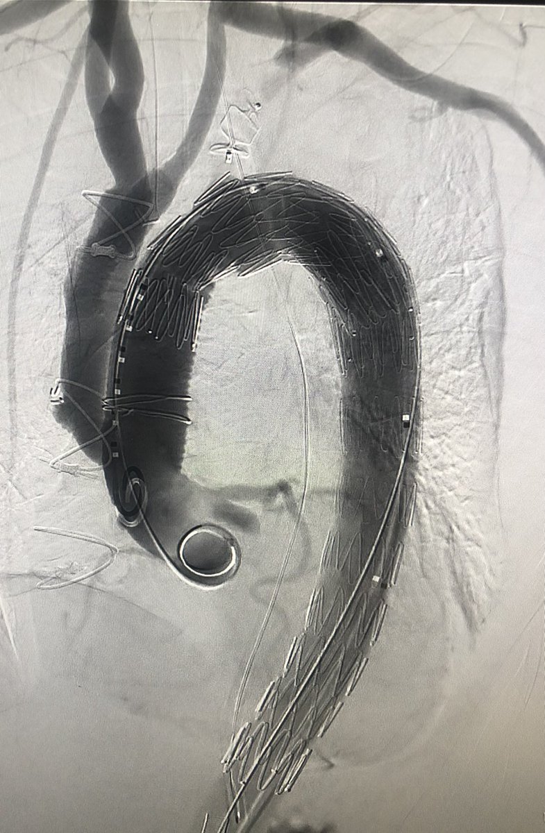 AndrewNiekampMD's tweet photo. Patient with Debakey 1 aortic dissection. Debranching by cardiothoracic surgery, carotid-subclavian bypass by vascular surgery and endograft placement by @MiamiVasc #collaborativemedicine #multidisciplinary #irad https://t.co/pfEhKpXdYu