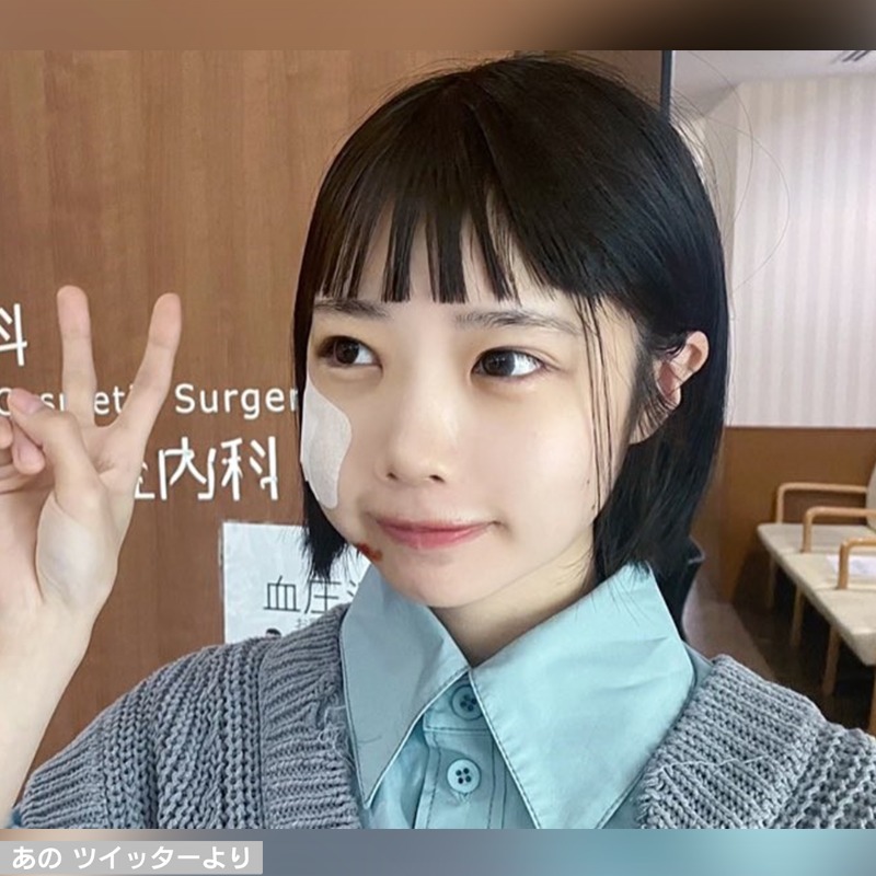 あのちゃん”バイクで転倒 顔を骨折「手術は後日」】 「ゆるめるモ