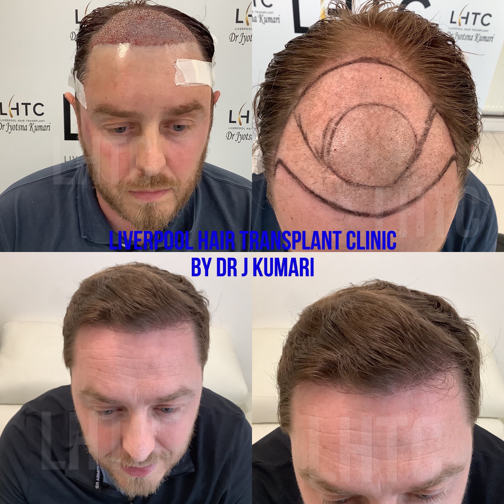 Liverpool Hair Transplant Clinic on Twitter: 