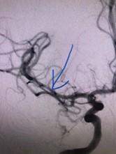 PenNeuro's tweet image. US HCPs: #RED72 delivers results in the hands of Dr. Tarpley at the Providence Little Company
of Mary Medical Center in Torrance, CA. #REDglideDifference #StrokeAwarenessMonth Rx only. For risk
info: bit.ly/37YcYIU Clinical results may vary.