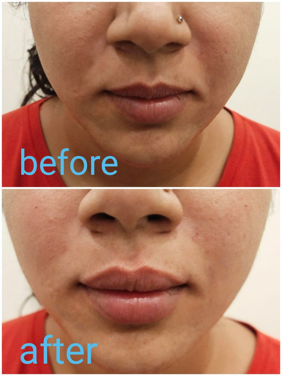 Lip filler 

#bonitaa #lippigmendation #skin #skintreatement #laser