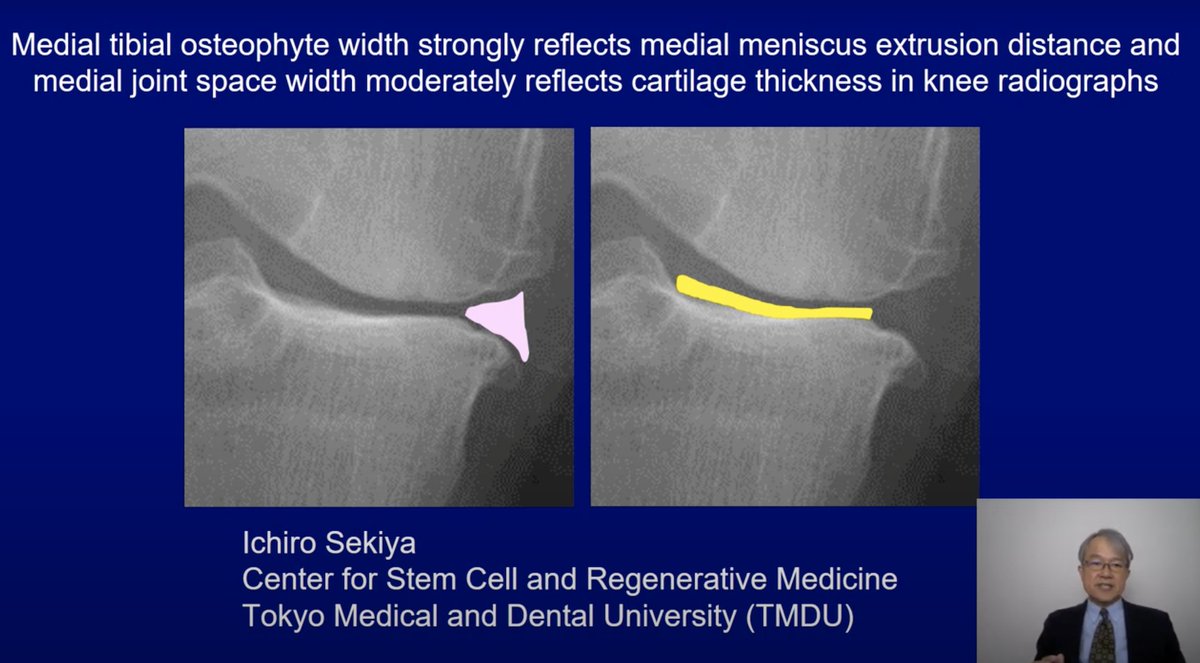 New Audioslide! Medial Tibial Osteophyte Width Strongly Reflects Medial Meniscus Extrusion Distance and Medial Joint Space Width Moderately Reflects Cartilage Thickness in Knee Radiographs youtu.be/vPDp5WOofK4