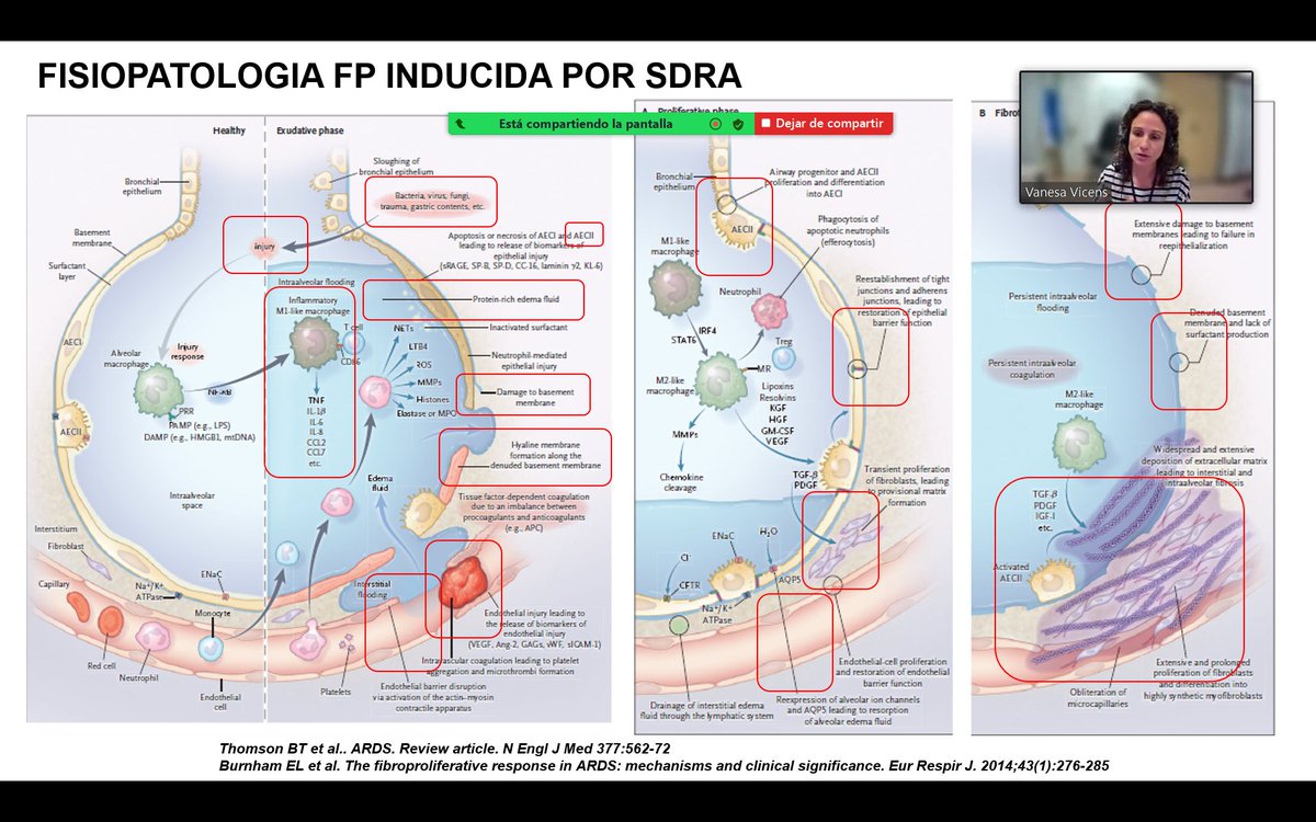 fundaciobrn's tweet photo. Brillante presentación de la Dra. Vanessa Vicens  de @hbellvitge "AFECTACIÓN #INTERSTICIAL #POSTCOVID" moderada por @mariamolinao 

Podéis seguir el seminario al siguiente enlace: https://t.co/09inwrOnTw
Código de acceso: 171753 https://t.co/vcC5VlEefA