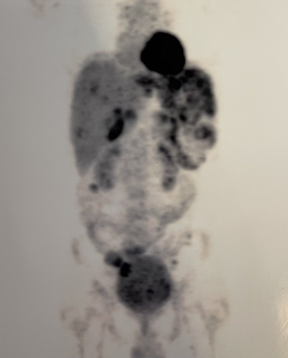 devavrat arya (@devavrat_arya) on Twitter photo Desmoplastic Round Cell Tumour - Excellent response to Induction chemotherapy- allowed GI surgeons to do R0 resection.
<a href="/GIoncology_MICC/">GI & HPB Oncology DMG Max Institute of Cancer Care</a> <a href="/Ortho_OncoMICC/">Musculoskeletal Oncology DMG, MICC</a> <a href="/harit_oncochat/">Harit Chaturvedi</a> <a href="/manishdoc2000/">Manish Jain</a> <a href="/WinningCancer/">Winning Against Cancer</a> Desmoplastic Round Cell Tumour - Excellent response to Induction chemotherapy- allowed GI surgeons to do R0 resection.
<a href="/GIoncology_MICC/">GI & HPB Oncology DMG Max Institute of Cancer Care</a> <a href="/Ortho_OncoMICC/">Musculoskeletal Oncology DMG, MICC</a> <a href="/harit_oncochat/">Harit Chaturvedi</a> <a href="/manishdoc2000/">Manish Jain</a> <a href="/WinningCancer/">Winning Against Cancer</a>