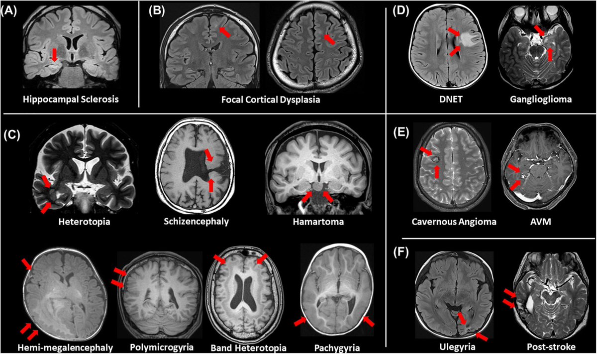 Sometimes epileptogenic lesions are visible on MR(red arrows).We should always keep in mind these lesions first👌
A) Hippocampal sclerosis B)focal cortical dysplasia C) other malformations of cortical development D) neoplasms E) vascular malformations F)cerebrovascular lesions