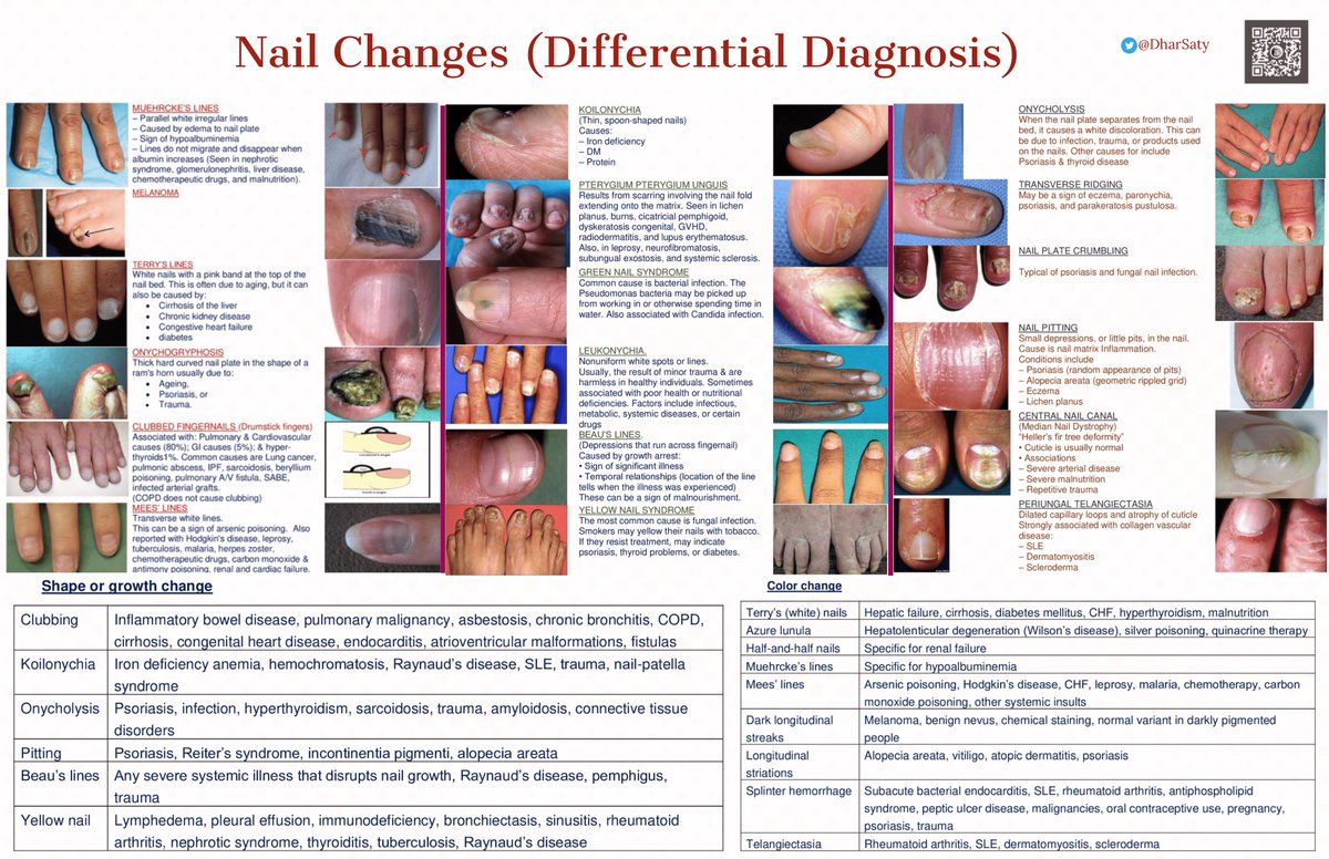 NAIL CHANGES
Clubbing, which is one example of a nail manifestation of systemic disease, was first described by Hippocrates in the 5th century B.C. Careful examination of the fingernails &amp; toenails can provide clues to underlying systemic diseases. See 👇 
<a href="/grepmeded/">GrepMed</a> #MedEd 
👇👇