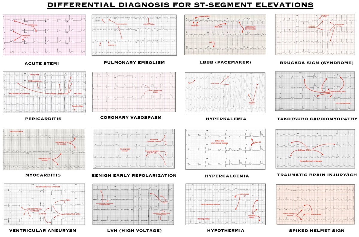 PatologCritica's tweet photo. Diagnóstico Diferencial de la Elevación del #SegmentoST!!!
Otro buen Resumen Visual para guardar!!!
#ECG https://t.co/AhWb0nSIuP