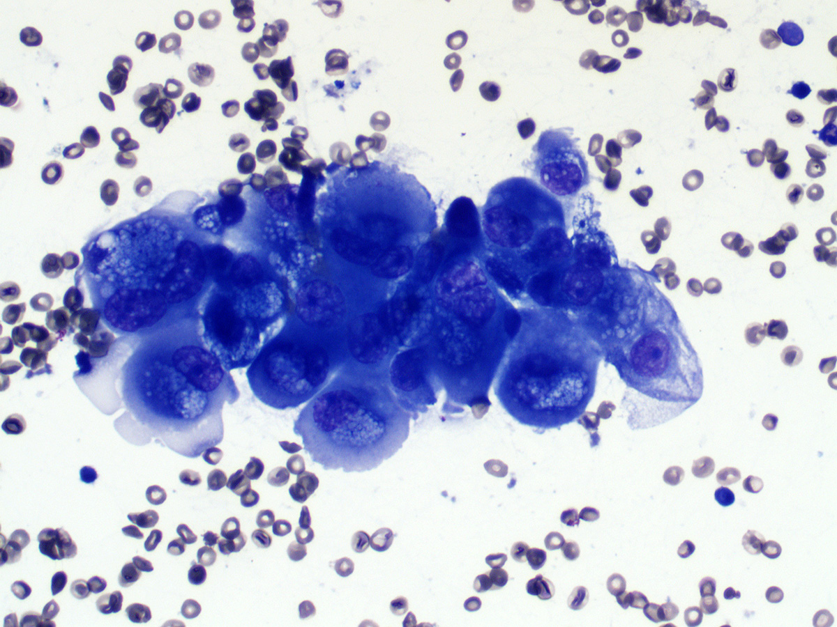 gcai1978's tweet image. 67/F with an enlarged right neck level 5 lymph node. How would you call it? #cytopath #cytology