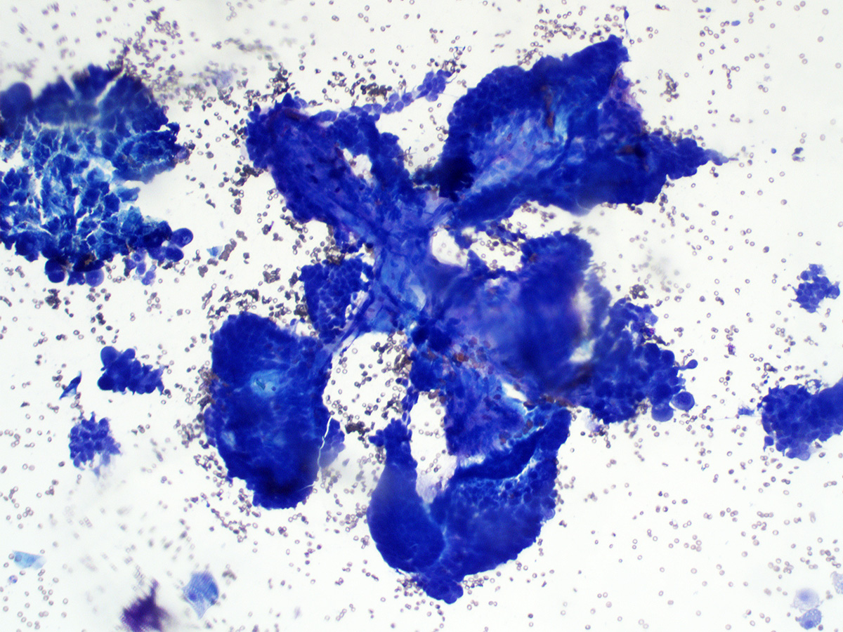 gcai1978's tweet image. 67/F with an enlarged right neck level 5 lymph node. How would you call it? #cytopath #cytology