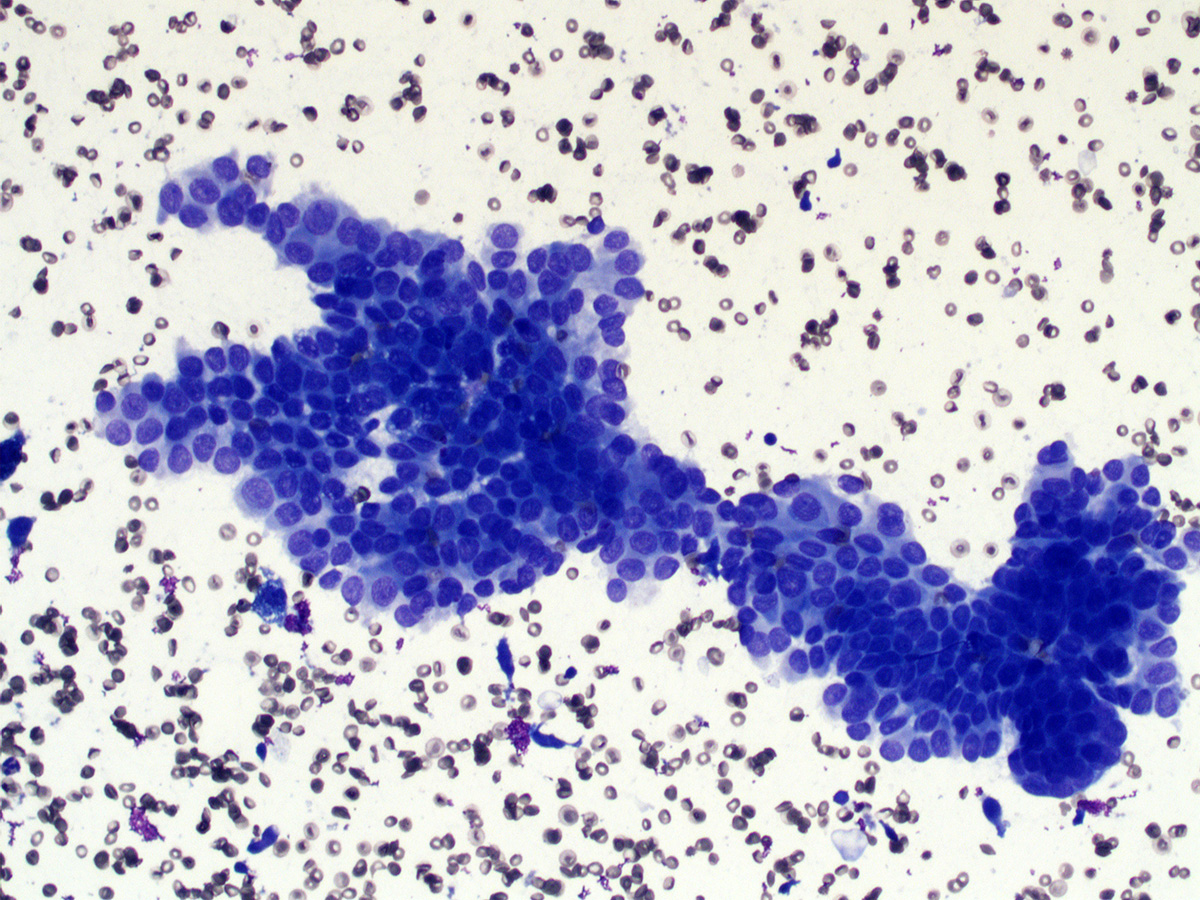 gcai1978's tweet image. 67/F with an enlarged right neck level 5 lymph node. How would you call it? #cytopath #cytology