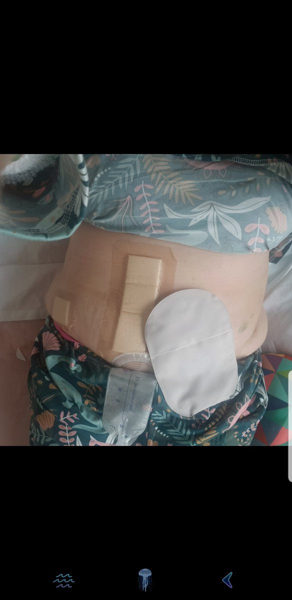 Polly Possible . Ostomy life for me . tweet media