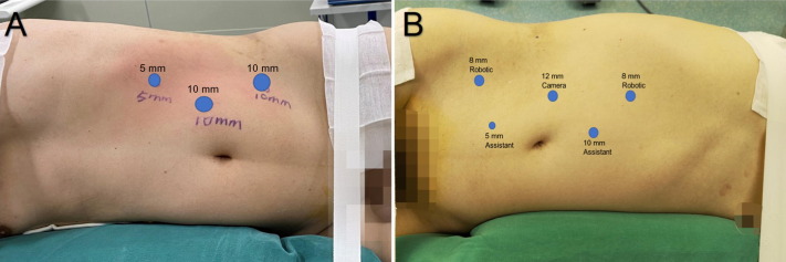 EUplatinum's tweet photo. New Surgery in Motion

Lingual Mucosal Graft Ureteroplasty for Long Proximal Ureteral Stricture: 6 Years of Experience with 41 Cases

https://t.co/ITQk7UufKE

"LMGU is a safe, feasible, and effective long-term technique for managing long, complex proximal ureteral strictures" https://t.co/YnSMpfnYIN