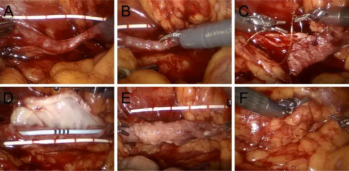 EUplatinum's tweet photo. New Surgery in Motion

Lingual Mucosal Graft Ureteroplasty for Long Proximal Ureteral Stricture: 6 Years of Experience with 41 Cases

https://t.co/ITQk7UufKE

"LMGU is a safe, feasible, and effective long-term technique for managing long, complex proximal ureteral strictures" https://t.co/YnSMpfnYIN