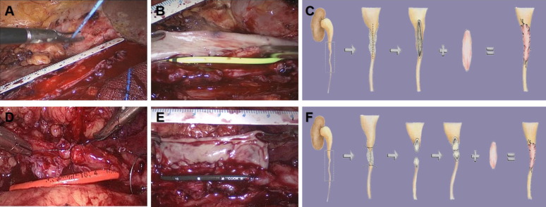 EUplatinum's tweet photo. New Surgery in Motion

Lingual Mucosal Graft Ureteroplasty for Long Proximal Ureteral Stricture: 6 Years of Experience with 41 Cases

https://t.co/ITQk7UufKE

"LMGU is a safe, feasible, and effective long-term technique for managing long, complex proximal ureteral strictures" https://t.co/YnSMpfnYIN