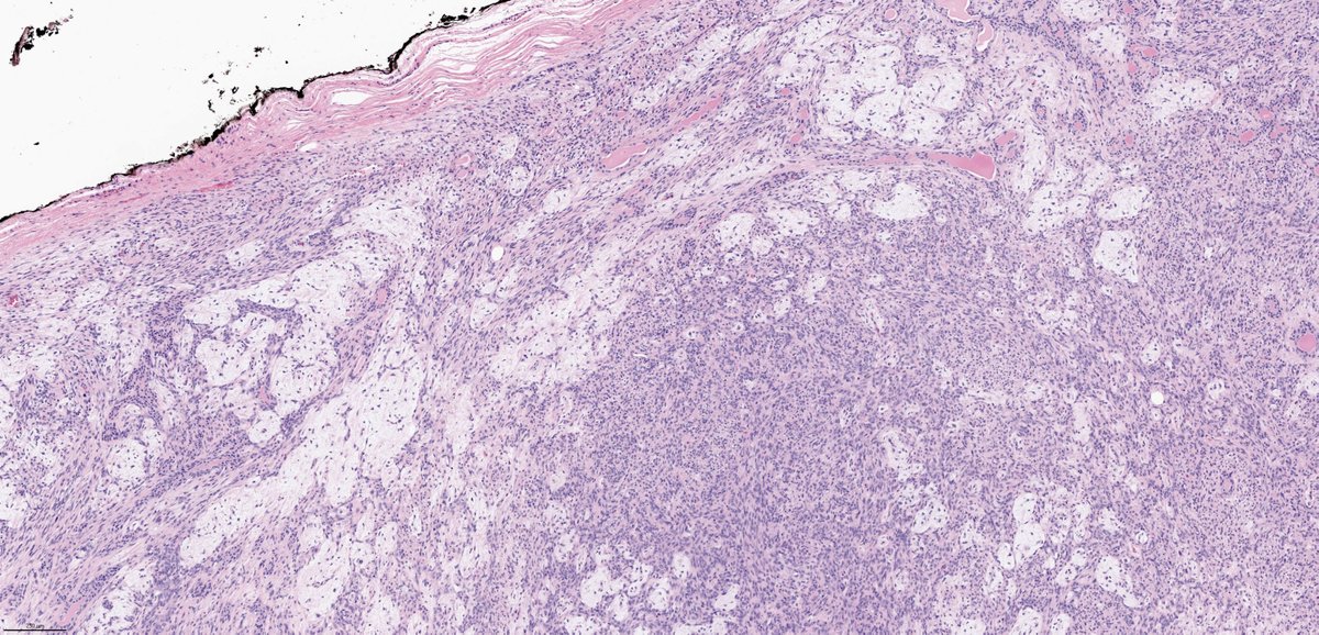 Pleomorphic adenoma of parotid gland: gross-micro correlation. #ENTpath #pathology