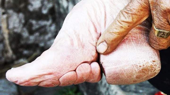 tHeSuperSaid's tweet photo. Foot Binding was a Chinese tradition in the 1940’s to make women appear ‘more beautiful’ to men. #ToeJam #HammaTime #Bunions https://t.co/YnrRhWiR90