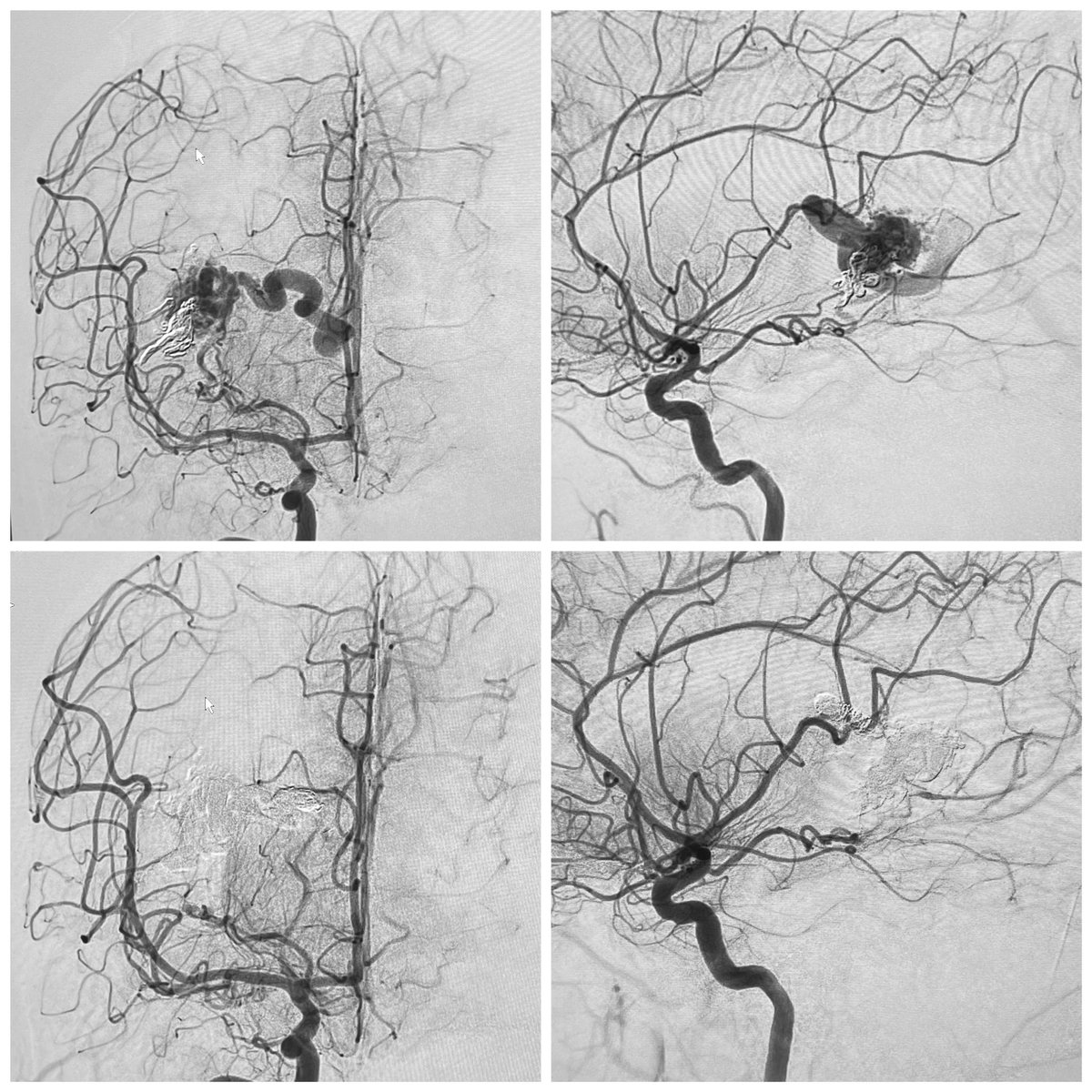 Hazem Shoirah (@shoirahz) on Twitter photo Transvenous reverse pressure cooker technique for AVM cure.. a new frontier for minimally invasive curative AVM management. #ReneChapot #Berenstein <a href="/johannatfifi/">Johanna T. Fifi, MD</a> <a href="/MountSinaiNeuro/">Mount Sinai Neurosurgery</a> Transvenous reverse pressure cooker technique for AVM cure.. a new frontier for minimally invasive curative AVM management. #ReneChapot #Berenstein <a href="/johannatfifi/">Johanna T. Fifi, MD</a> <a href="/MountSinaiNeuro/">Mount Sinai Neurosurgery</a>