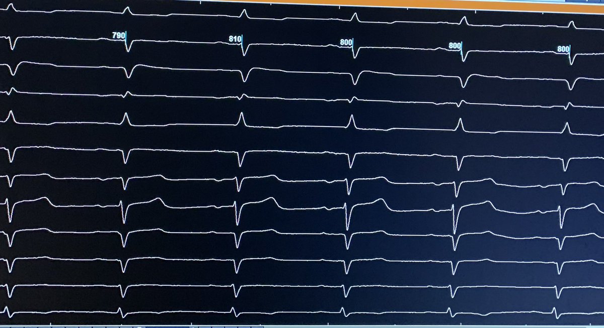 52 yo M, EF <30%, Holter 44.1% PVC burden.  Presented in bigeminy and runs of NSVT.  25 ms pre-QRS in distal CS.  Close to coronary on angio.  Successfully ablated from LVOT adjacent to early site in CS.  Thanks for the great mapping. <a href="/EP_JB13/">John Burke</a> @BiosenseWebster