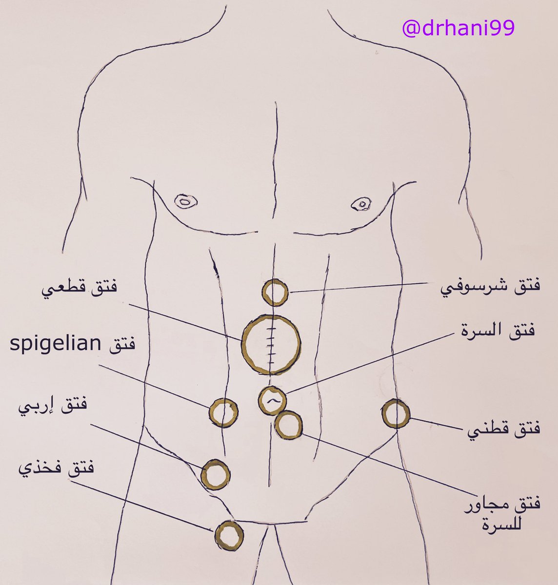#الفتاق_وأنواعه