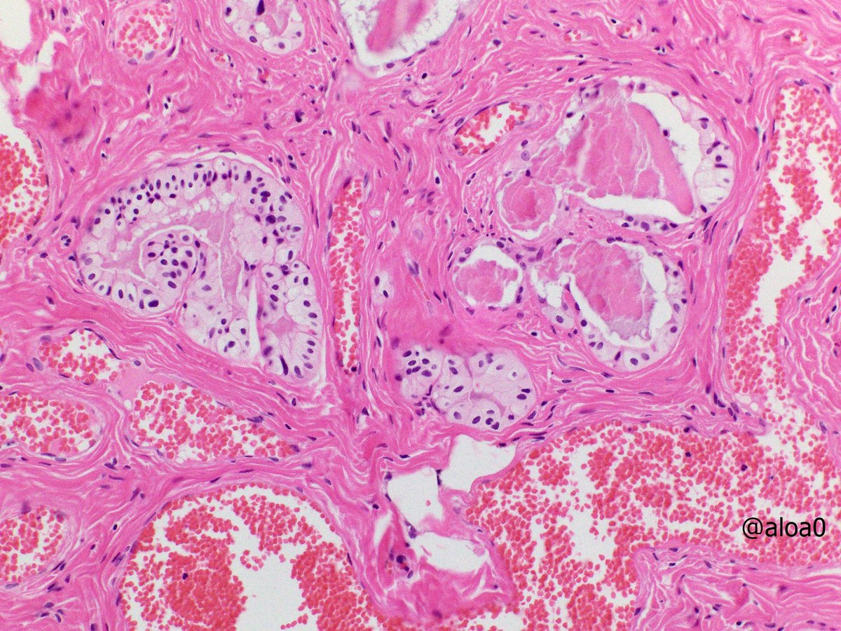 aloa0's tweet photo. Unexpected glandular structure abutting a parathyroid gland and thymic tissue in 'level VI LN' specimen of thyroidectomy (classic type PTC, pT3N0). Can someone shed light on what these glands are? #ENTpath #Endopath #Thoracicpath 1/2 https://t.co/I1v9aT9YHd