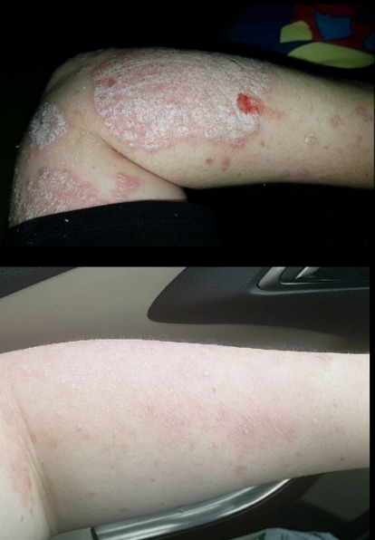 psoriasisexp's tweet photo. My very first (hopefully only 😉) before & after! One Humira injection & two weeks later. My next injection is tomorrow and I have never been so excited to stab myself lol 😂
#psoriasissupport
#psoriasissufferer
#psoriasisrelief
#psoriasisproblems
#psoriasisactionmonth https://t.co/fgGc5Mdjzj